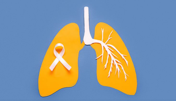 lung cancer treatment options